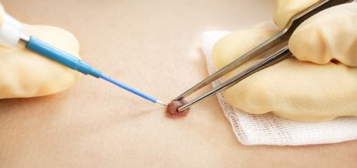 Mole removal treatment in Mumbai