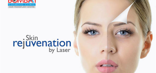 Skin laser treatment in Vashi
