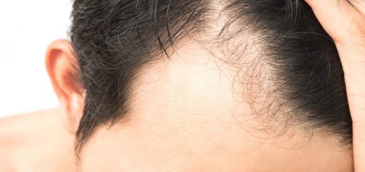 are you the right candidate for hair transplant